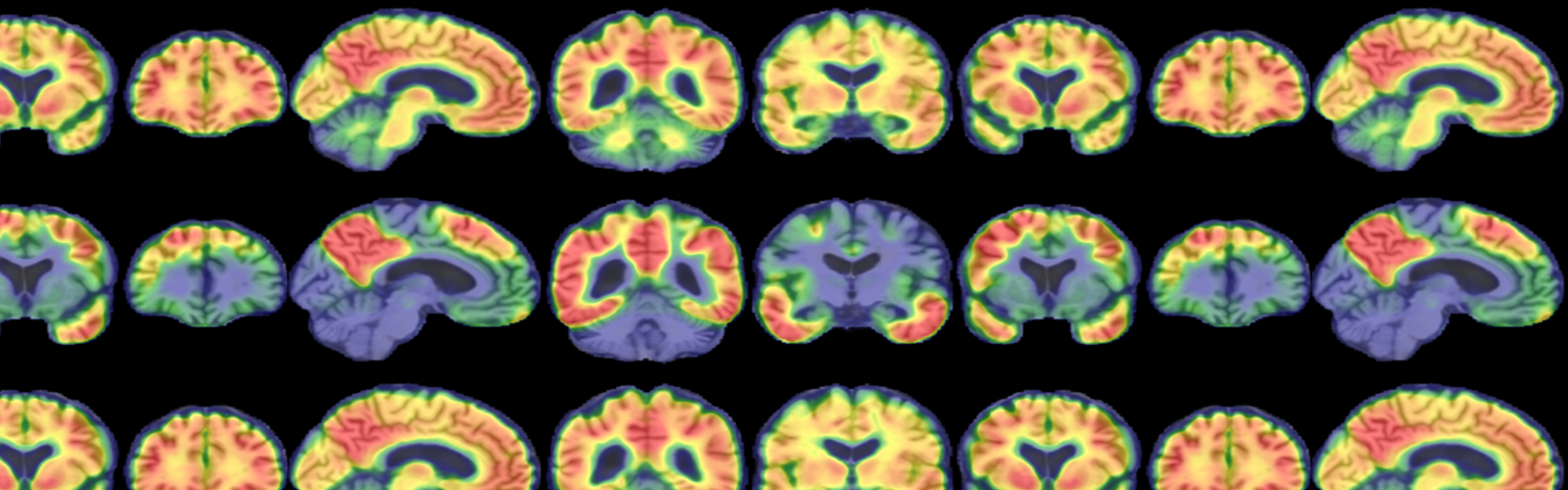 PET Scan